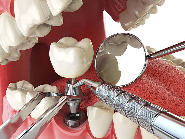 Best Broken or Cracked Tooth Emergency Dentist in Newman, CA